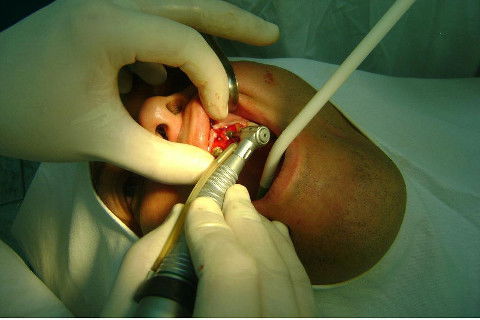 Reabilitação com Implantes em Situações de Colapso Oclusal
