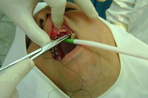 Reabilitação com Implantes em Situações de Colapso Oclusal