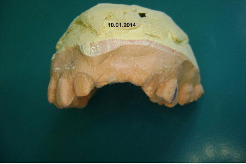 Reabilitação com Implantes em Situações de Colapso Oclusal