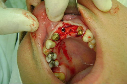 Reabilitação com Implantes em Situações de Colapso Oclusal