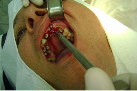Reabilitação com Implantes em Situações de Colapso Oclusal
