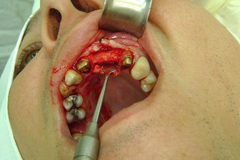 Reabilitação com Implantes em Situações de Colapso Oclusal