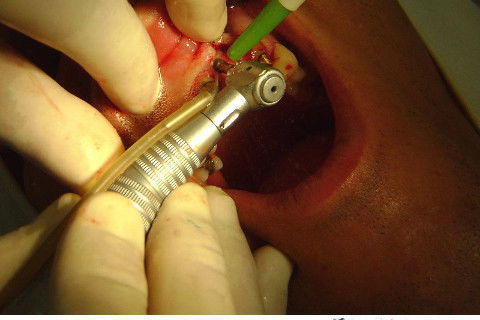 Reabilitação com Implantes em Situações de Colapso Oclusal