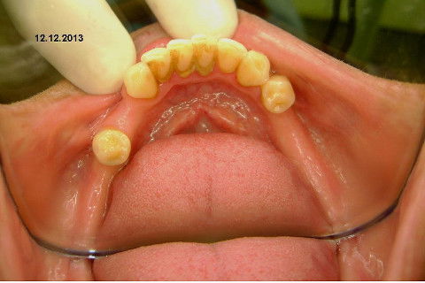 Reabilitação com Implantes em Situações de Colapso Oclusal