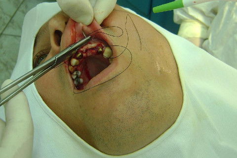 Reabilitação com Implantes em Situações de Colapso Oclusal