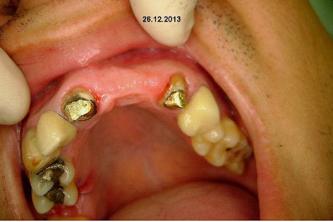 Reabilitação com Implantes em Situações de Colapso Oclusal