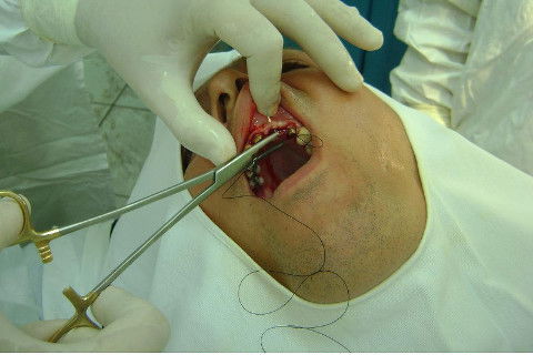 Reabilitação com Implantes em Situações de Colapso Oclusal