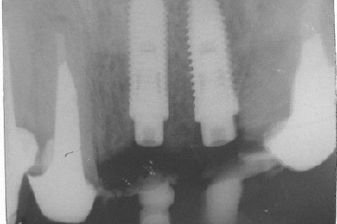Reabilitação com Implantes em Situações de Colapso Oclusal