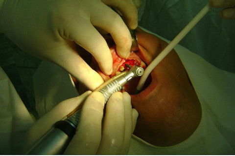 Reabilitação com Implantes em Situações de Colapso Oclusal