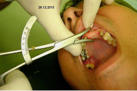 Reabilitação com Implantes em Situações de Colapso Oclusal