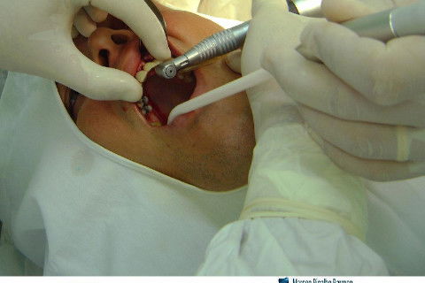 Reabilitação com Implantes em Situações de Colapso Oclusal