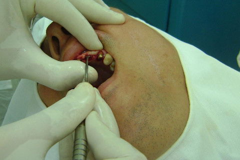 Reabilitação com Implantes em Situações de Colapso Oclusal