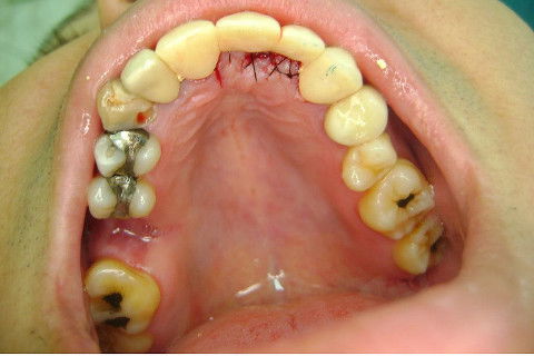 Reabilitação com Implantes em Situações de Colapso Oclusal