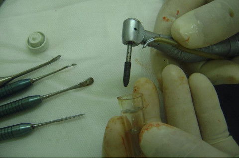 Reabilitação com Implantes em Situações de Colapso Oclusal