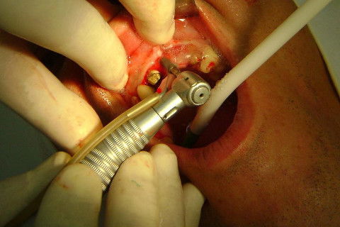 Reabilitação com Implantes em Situações de Colapso Oclusal
