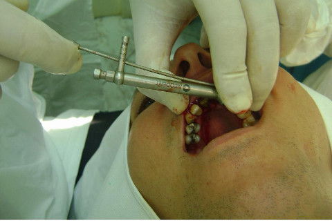 Reabilitação com Implantes em Situações de Colapso Oclusal