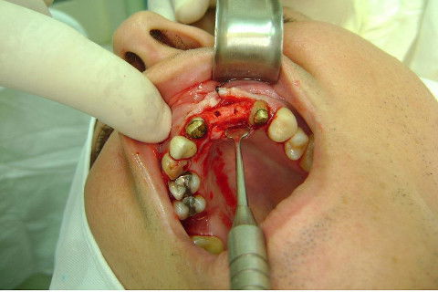 Reabilitação com Implantes em Situações de Colapso Oclusal