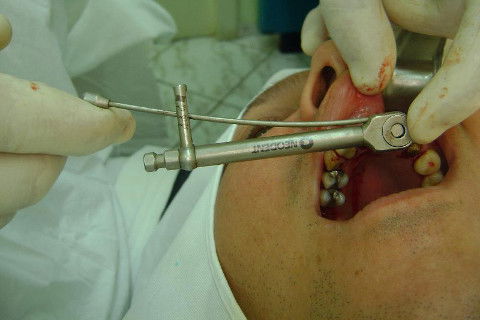 Reabilitação com Implantes em Situações de Colapso Oclusal