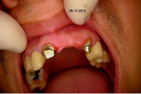 Reabilitação com Implantes em Situações de Colapso Oclusal