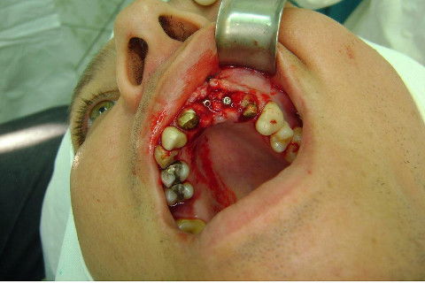 Reabilitação com Implantes em Situações de Colapso Oclusal