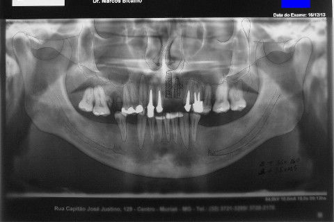 Reabilitação com Implantes em Situações de Colapso Oclusal