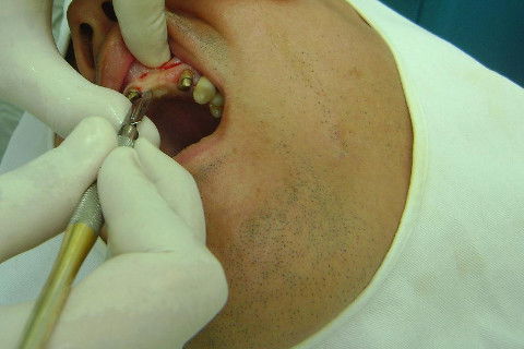 Reabilitação com Implantes em Situações de Colapso Oclusal