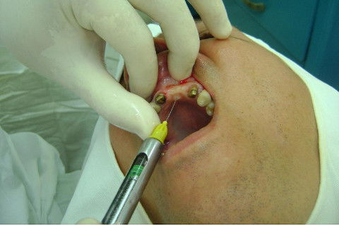 Reabilitação com Implantes em Situações de Colapso Oclusal