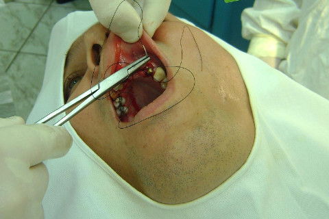 Reabilitação com Implantes em Situações de Colapso Oclusal