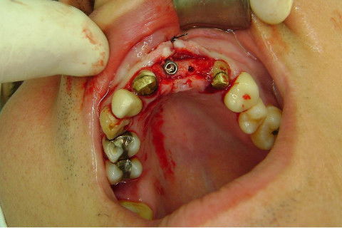 Reabilitação com Implantes em Situações de Colapso Oclusal