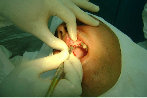 Reabilitação com Implantes em Situações de Colapso Oclusal