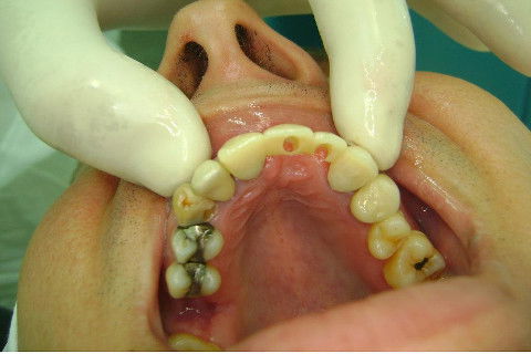 Reabilitação com Implantes em Situações de Colapso Oclusal