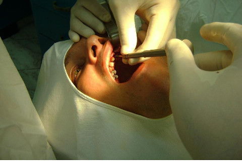 Reabilitação com Implantes em Situações de Colapso Oclusal