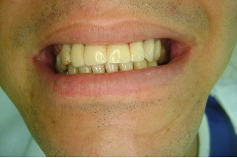 Reabilitação com Implantes em Situações de Colapso Oclusal