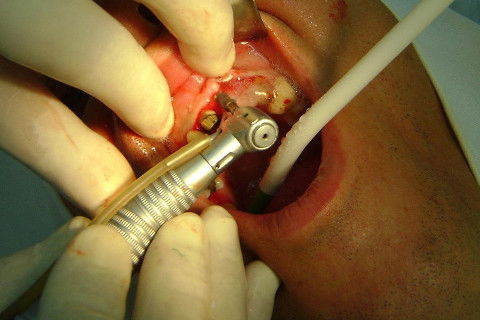 Reabilitação com Implantes em Situações de Colapso Oclusal