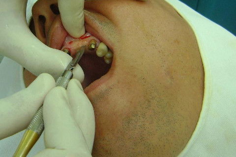 Reabilitação com Implantes em Situações de Colapso Oclusal