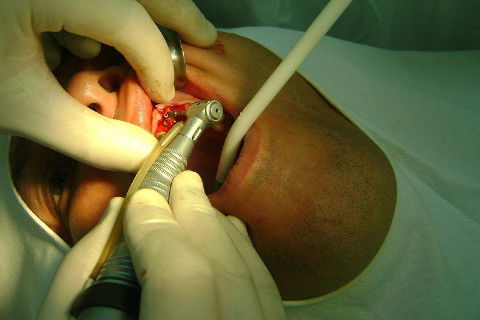 Reabilitação com Implantes em Situações de Colapso Oclusal