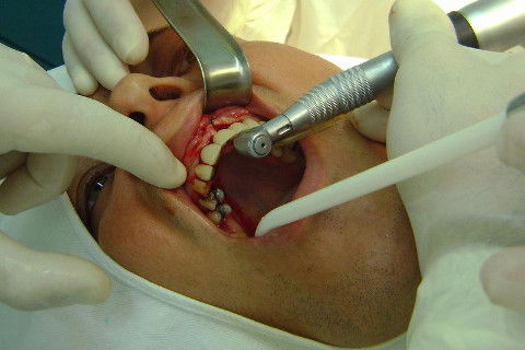 Reabilitação com Implantes em Situações de Colapso Oclusal