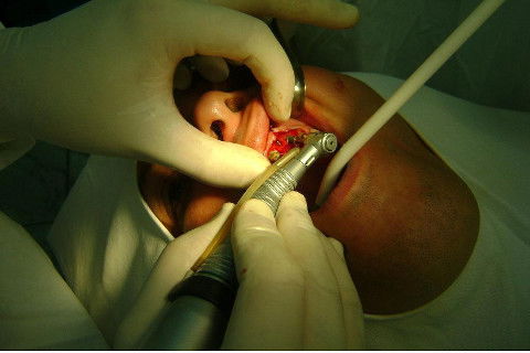 Reabilitação com Implantes em Situações de Colapso Oclusal