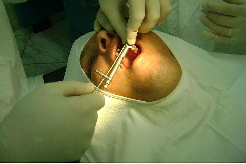 Reabilitação com Implantes em Situações de Colapso Oclusal