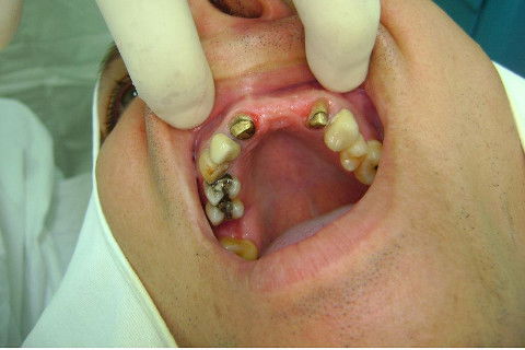 Reabilitação com Implantes em Situações de Colapso Oclusal