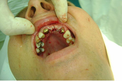 Reabilitação com Implantes em Situações de Colapso Oclusal