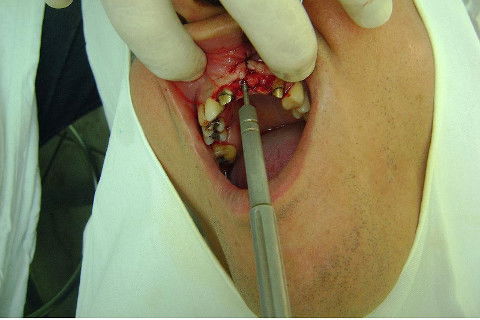 Reabilitação com Implantes em Situações de Colapso Oclusal