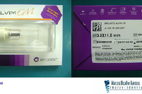 Reabilitação com Implantes em Situações de Colapso Oclusal