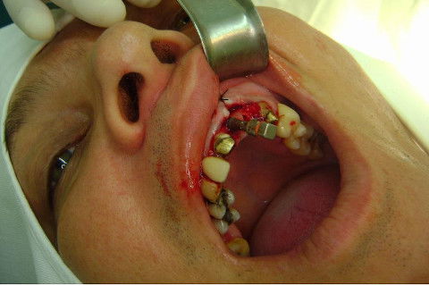 Reabilitação com Implantes em Situações de Colapso Oclusal
