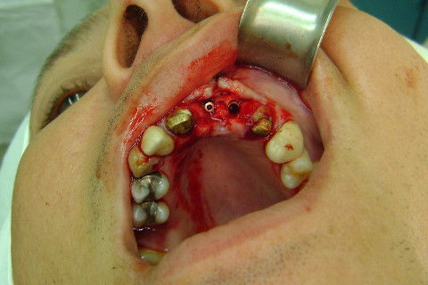 Reabilitação com Implantes em Situações de Colapso Oclusal