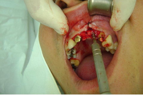 Reabilitação com Implantes em Situações de Colapso Oclusal