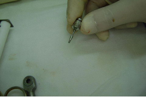 Reabilitação com Implantes em Situações de Colapso Oclusal