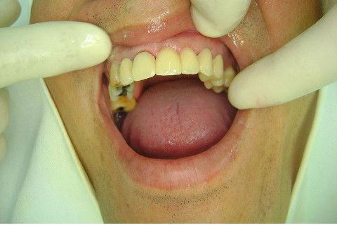 Reabilitação com Implantes em Situações de Colapso Oclusal