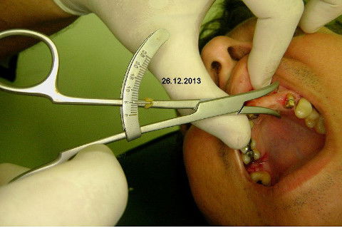 Reabilitação com Implantes em Situações de Colapso Oclusal