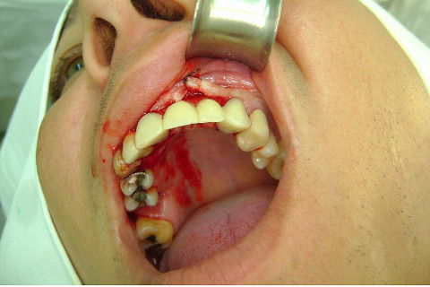 Reabilitação com Implantes em Situações de Colapso Oclusal